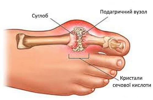 накопичення кристалів сечової кислоти в суглобах
