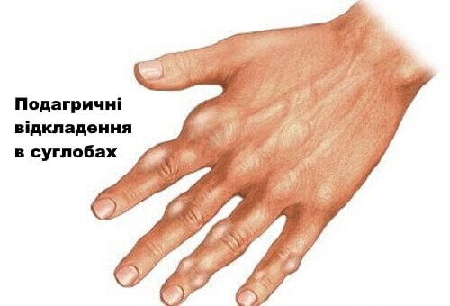 Як природним чином зменшити кількість сечової кислоти