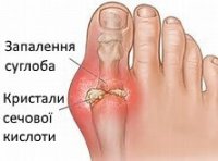 Небезпека сечової кислоти та як її уникнути