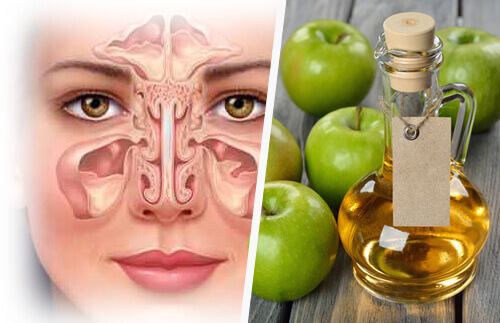 що викликає синусит