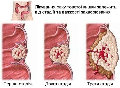 Що потрібно знати про рак товстої кишки