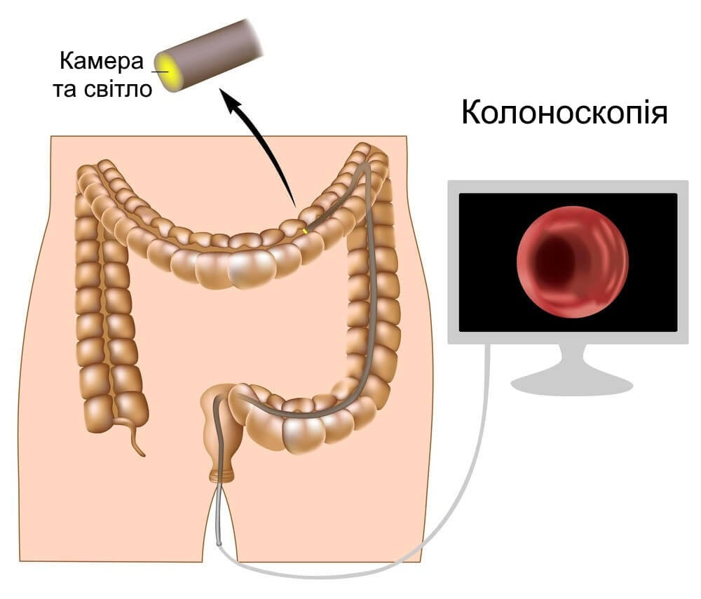 рак товстої кишки