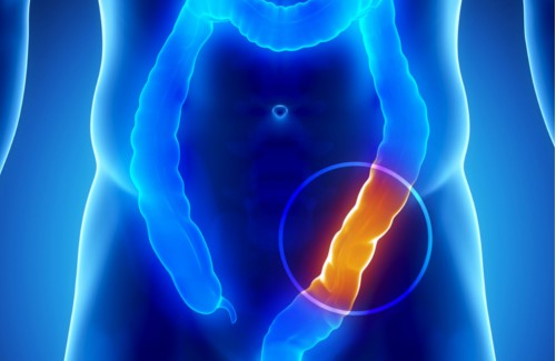 рак товстої кишки