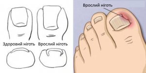 Врослий ніготь на ногах: лікування