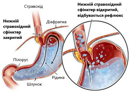 Поради для боротьби з кислотним рефлюксом