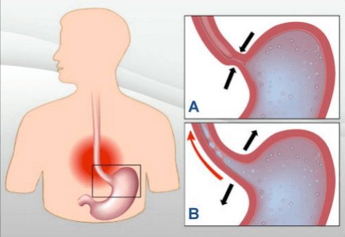 кислотний рефлюкс та шлунок