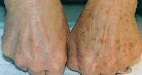 Як зменшити плями на руках
