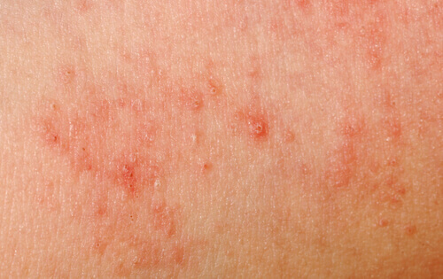 alergia