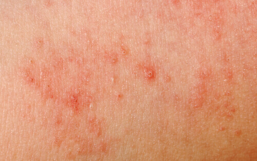 алергічна реакція шкіри