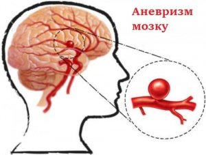 Аневризми головного мозку: що це таке і як запобігти?