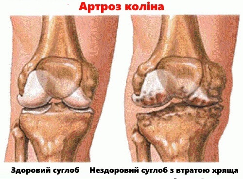Симптоми і профілактика артриту