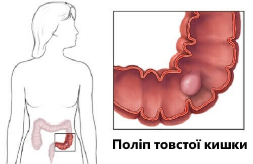 Поліпи товстої кишки: факти