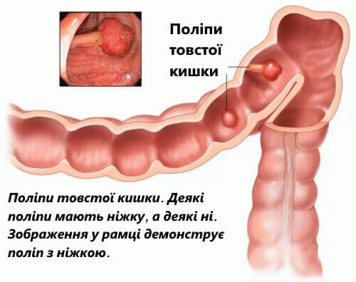 поліпи товстої кишки