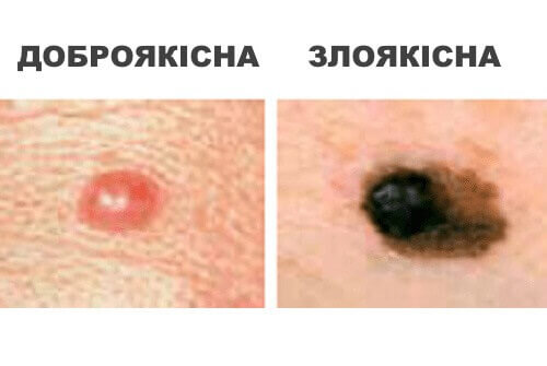 доброякісна та злоякісна родимки