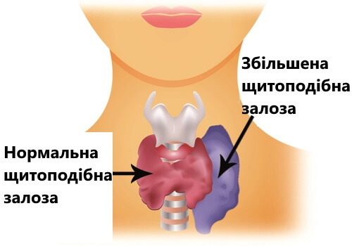 захворювання щитоподібної залози