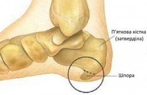Симптоми і лікування п'яткової шпори