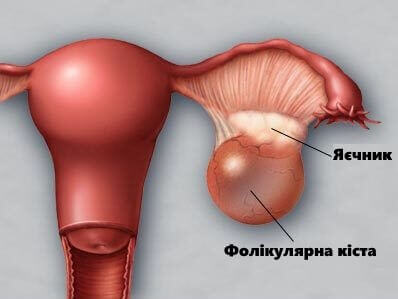 схематичне зображення кисти лівого яєчника