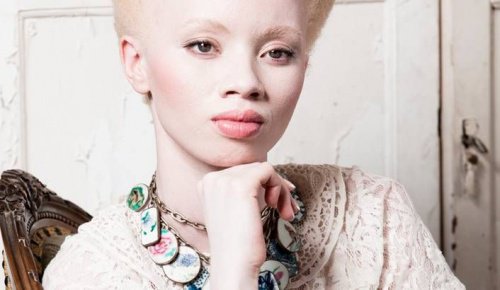 1-albinos