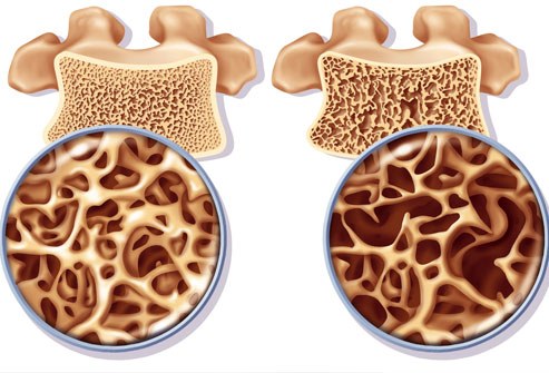 1-osteoporos