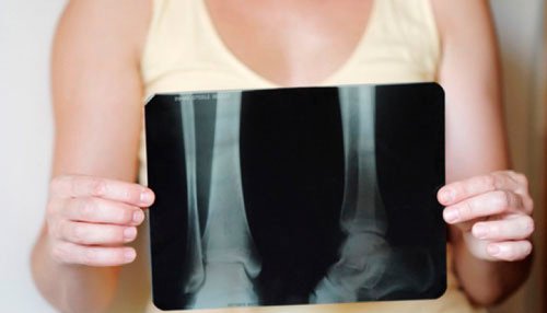 рентген показує остеопороз у жінок