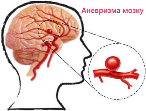 Виявлення аневризми і запобігання її появі