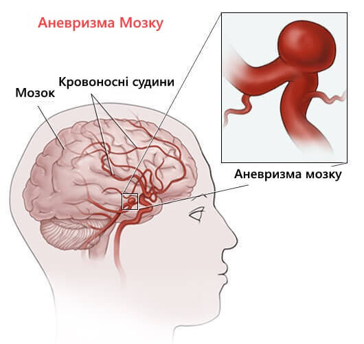 схема аневризми