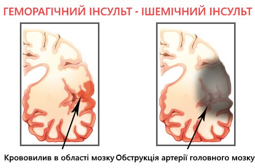 ризик інсульту серед наслідків недосипання