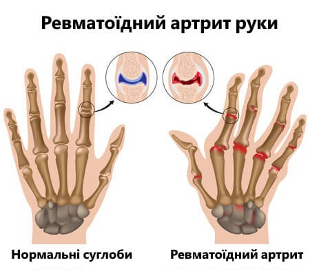 revmatyzm (2)
