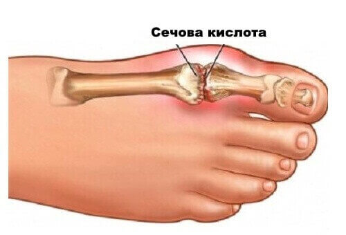 сечова кислота накопичується в суглобах