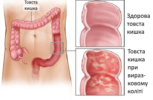 товста кишка