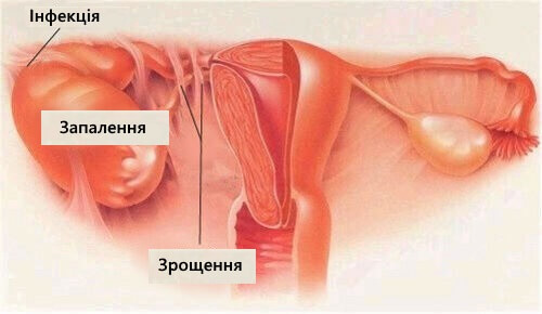 Про запальні захворювання жіночих статевих органів