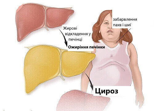 ожиріння печінки