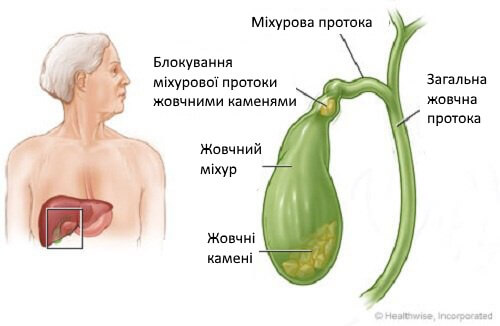 Як дізнатися, чи є у вас жовчні камені