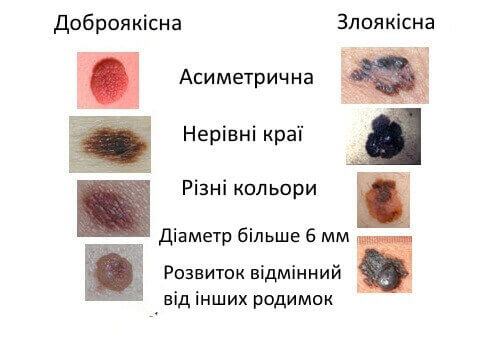 Ознаки і симптоми меланоми