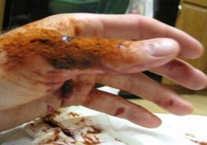 Гель, який зупиняє кровотечу всього за 10 секунд