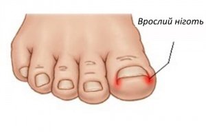Як вилікувати врослі нігті природними засобами