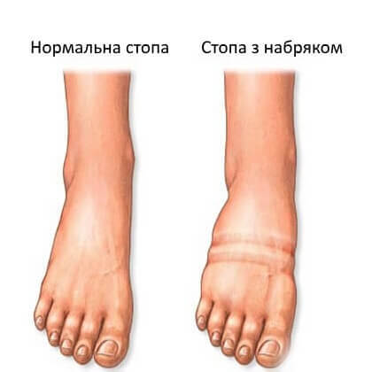 набряк стопи
