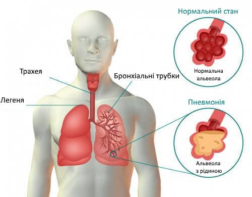 Симптоми і лікування пневмонії