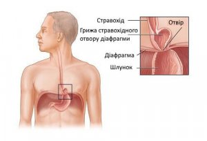 Як лікувати грижу стравохідного отвору діафрагми?