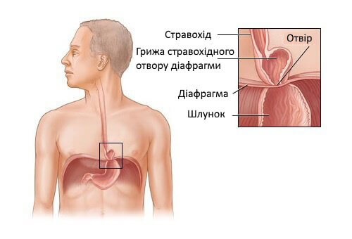 Як лікувати грижу стравохідного отвору діафрагми? Як лікувати грижу стравохідного отвору діафрагми?