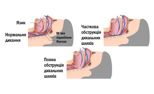 хропіння та його причини