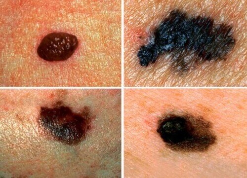 Навчіться діагностувати рак шкіри