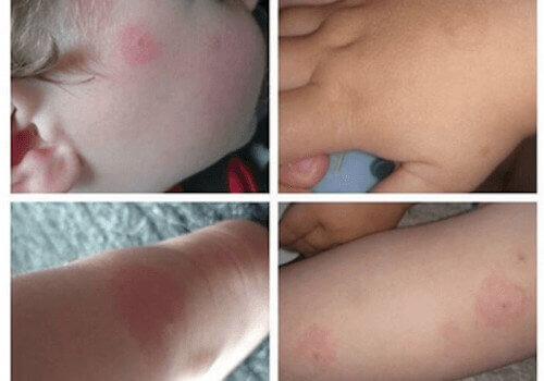 Хвороба Лайма та її ризики