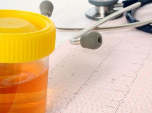 зміни в сечі як одна з ознак раку