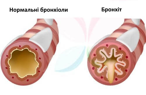 Що спричиняє кашель