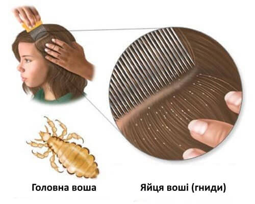 Засоби для лікування вошей на голові