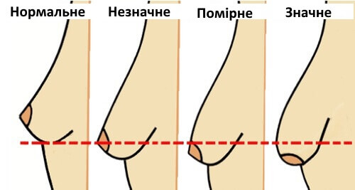 5 звичок, які викликають провисання грудей
