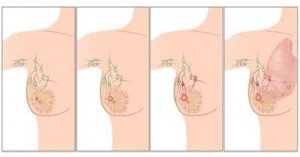 Основні причини раку молочної залози