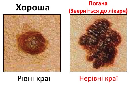 родимки як одна з ознак раку