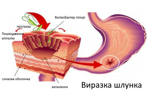 Натуральні засоби від виразки шлунку